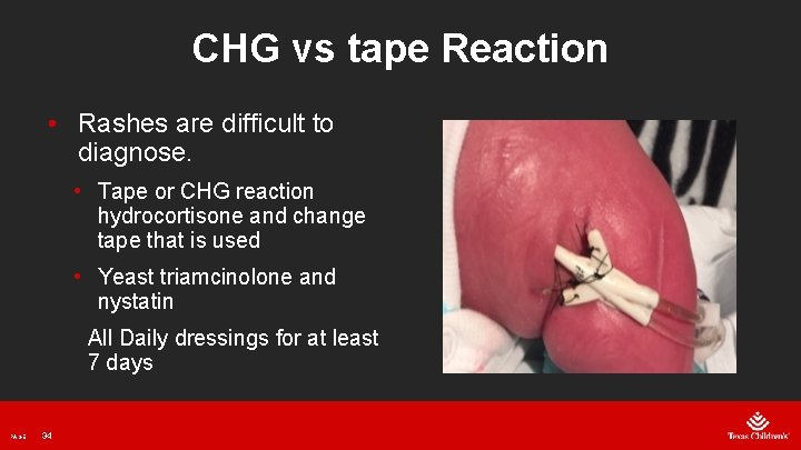 CHG vs tape Reaction • Rashes are difficult to diagnose. • Tape or CHG