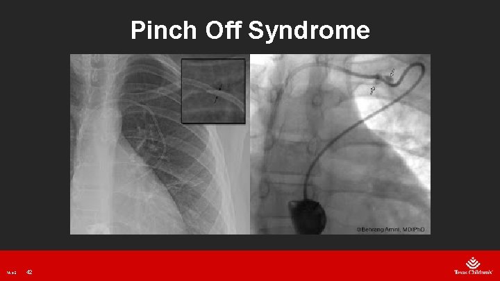 Pinch Off Syndrome PAGE 42 