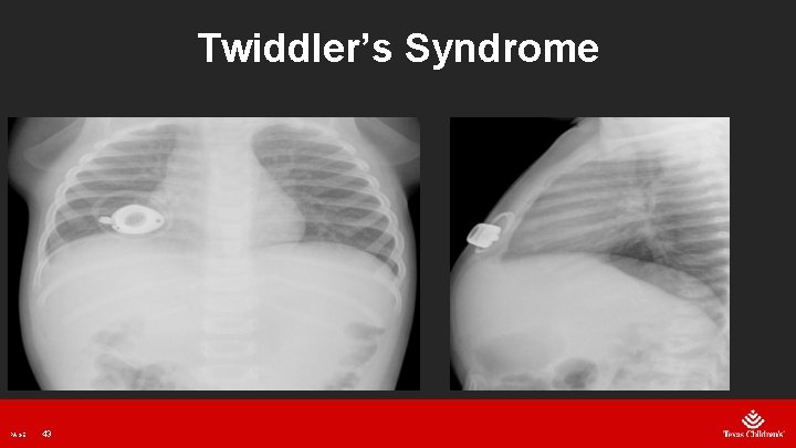 Twiddler’s Syndrome PAGE 43 