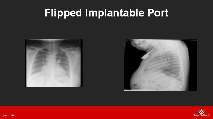 Flipped Implantable Port PAGE 46 