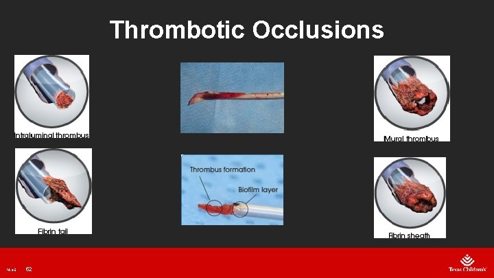 Thrombotic Occlusions PAGE 52 