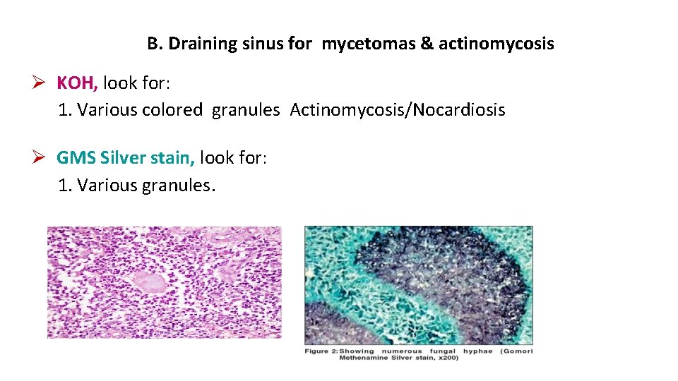 B. Draining sinus for mycetomas & actinomycosis KOH, look for: 1. Various colored granules