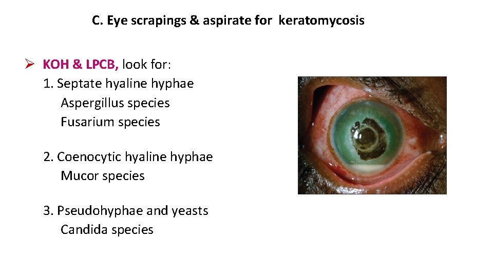 C. Eye scrapings & aspirate for keratomycosis KOH & LPCB, look for: 1. Septate