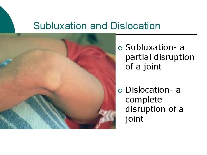 Subluxation and Dislocation ¡ ¡ Subluxation- a partial disruption of a joint Dislocation- a Subluxation and Dislocation ¡ ¡ Subluxation- a partial disruption of a joint Dislocation- a