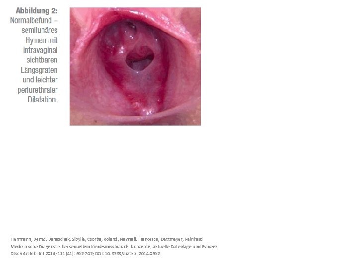 Herrmann, Bernd; Banaschak, Sibylle; Csorba, Roland; Navratil, Francesca; Dettmeyer, Reinhard Medizinische Diagnostik bei sexuellem
