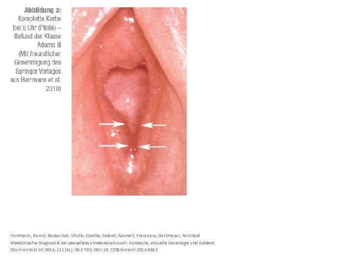 Herrmann, Bernd; Banaschak, Sibylle; Csorba, Roland; Navratil, Francesca; Dettmeyer, Reinhard Medizinische Diagnostik bei sexuellem