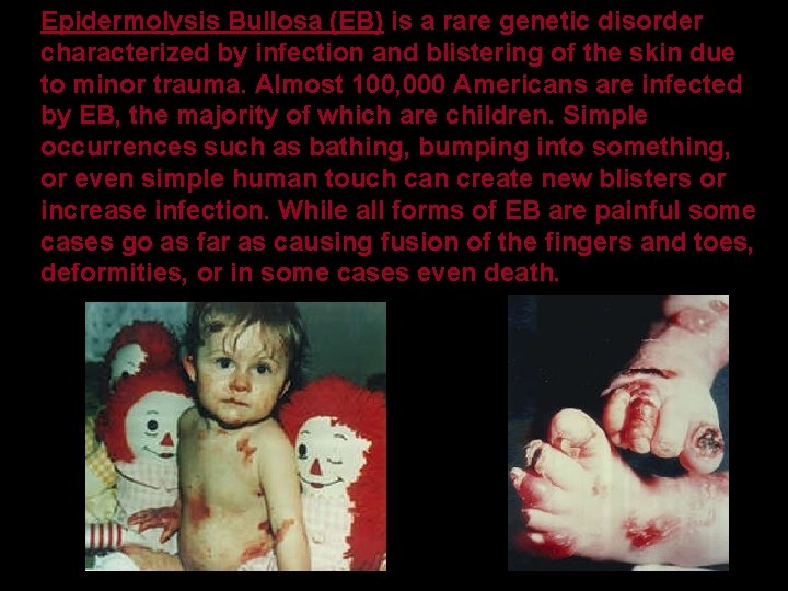 Epidermolysis Bullosa (EB) is a rare genetic disorder characterized by infection and blistering of