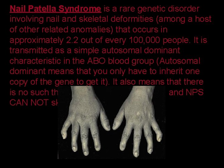 Nail Patella Syndrome is a rare genetic disorder involving nail and skeletal deformities (among
