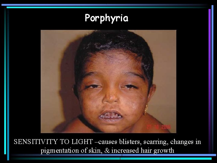 Porphyria SENSITIVITY TO LIGHT –causes blisters, scarring, changes in pigmentation of skin, & increased