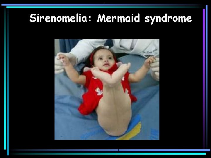 Sirenomelia: Mermaid syndrome 
