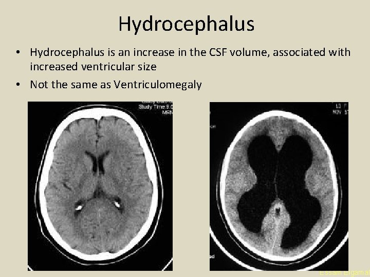Hydrocephalus • Hydrocephalus is an increase in the CSF volume, associated with increased ventricular