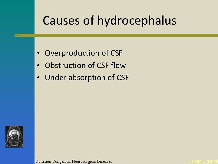 Causes of hydrocephalus • Overproduction of CSF • Obstruction of CSF flow • Under