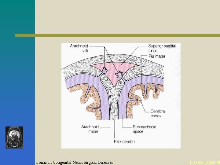 Common Congenital Neurosurgical Diseases Essam Elgamal 