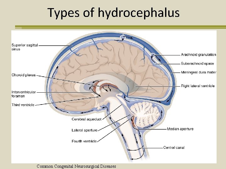 Types of hydrocephalus Common Congenital Neurosurgical Diseases 