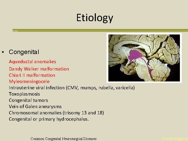 Etiology • Congenital Aqueductal anomalies Dandy Walker malformation Chiari II malformation Myleomeningocele Intrauterine viral