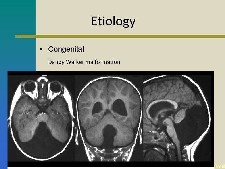 Etiology • Congenital Dandy Walker malformation Common Congenital Neurosurgical Diseases Essam Elgamal 