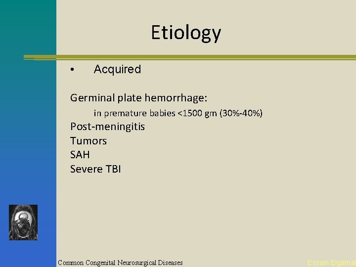 Etiology • Acquired Germinal plate hemorrhage: in premature babies <1500 gm (30%-40%) Post-meningitis Tumors