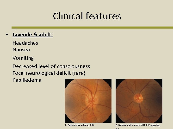 Clinical features • Juvenile & adult: Headaches Nausea Vomiting Decreased level of consciousness Focal