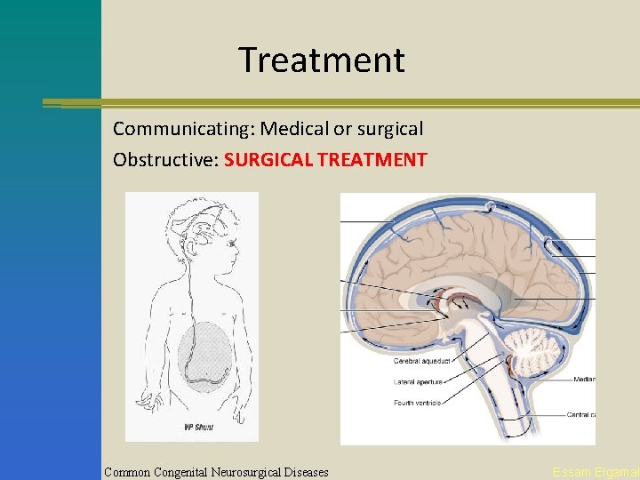 Treatment Communicating: Medical or surgical Obstructive: SURGICAL TREATMENT Common Congenital Neurosurgical Diseases Essam Elgamal
