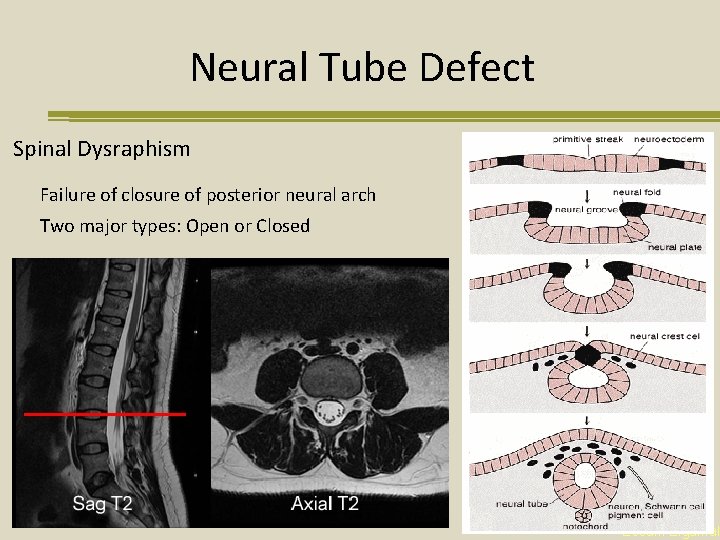 Neural Tube Defect Spinal Dysraphism Failure of closure of posterior neural arch Two major