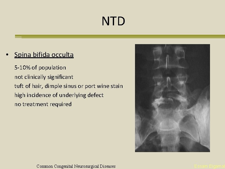 NTD • Spina bifida occulta 5 -10% of population not clinically significant tuft of