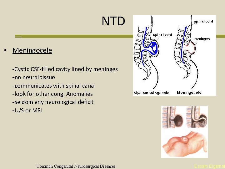 NTD • Meningocele -Cystic CSF-filled cavity lined by meninges -no neural tissue -communicates with