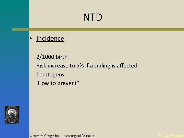 NTD • Incidence 2/1000 birth Risk increase to 5% if a sibling is affected