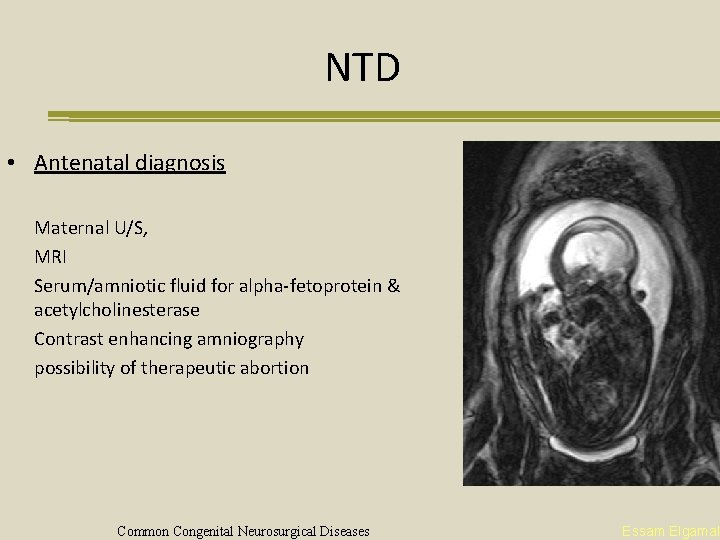 NTD • Antenatal diagnosis Maternal U/S, MRI Serum/amniotic fluid for alpha-fetoprotein & acetylcholinesterase Contrast