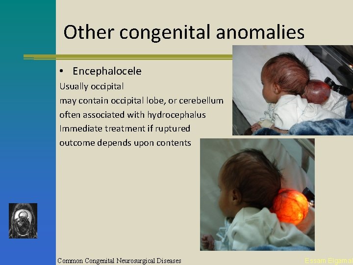 Other congenital anomalies • Encephalocele Usually occipital may contain occipital lobe, or cerebellum often