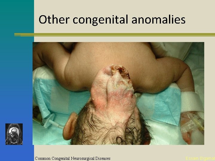 Other congenital anomalies Common Congenital Neurosurgical Diseases Essam Elgamal 