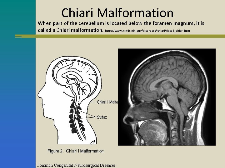 Chiari Malformation When part of the cerebellum is located below the foramen magnum, it