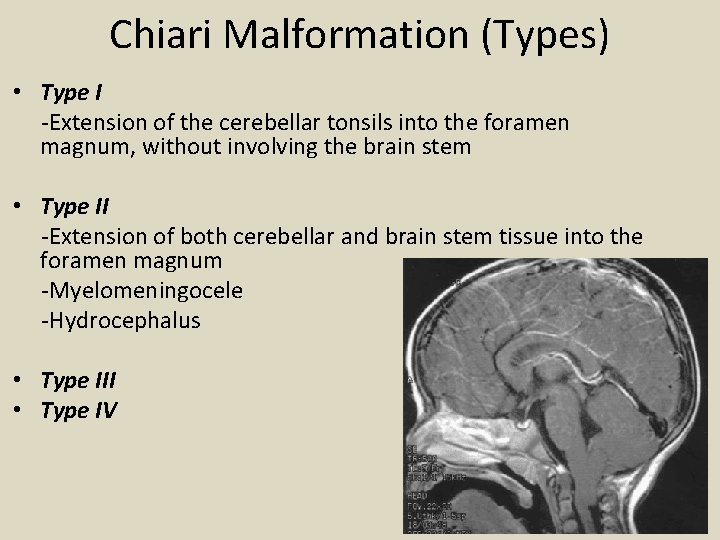 Chiari Malformation (Types) • Type I -Extension of the cerebellar tonsils into the foramen
