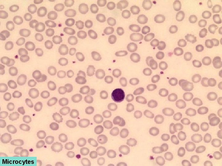 Microcytes 