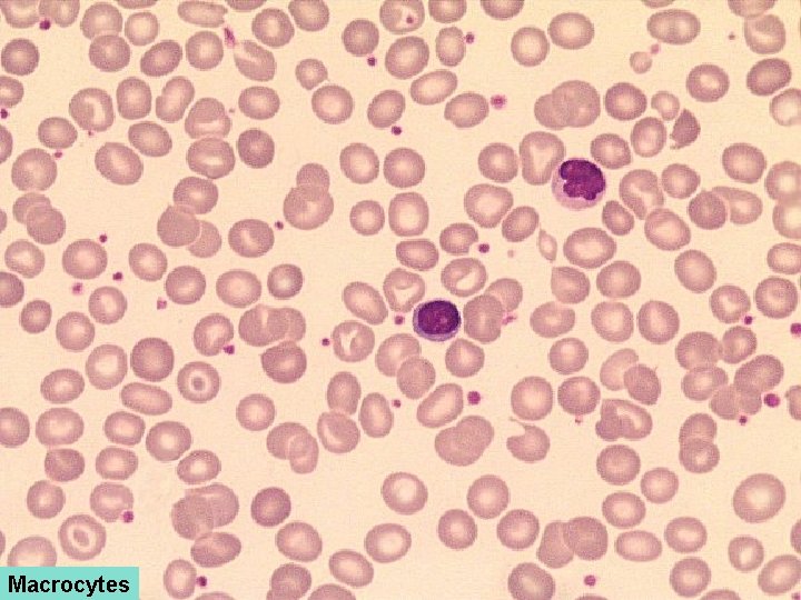 Macrocytes 