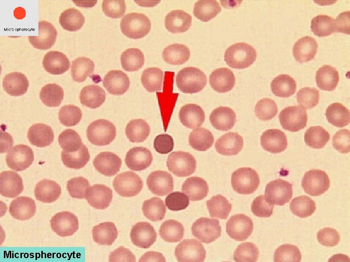 Microspherocyte 