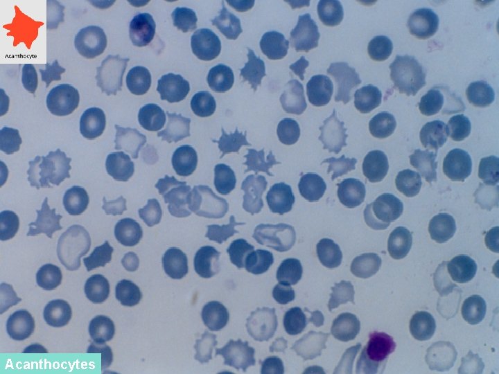 Acanthocytes 