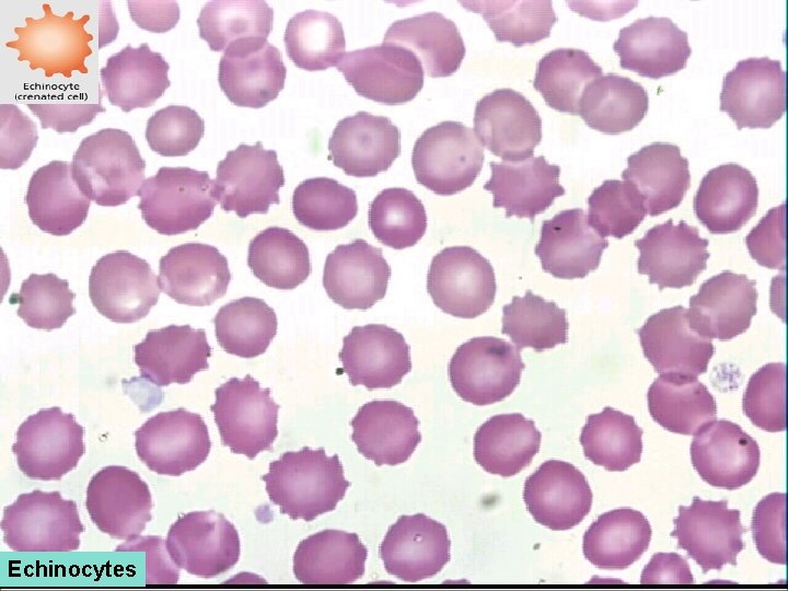 Echinocytes 