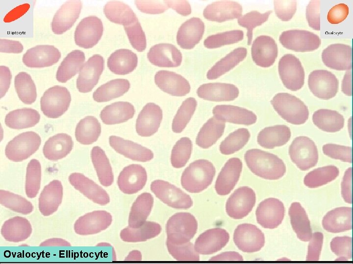 Ovalocyte - Elliptocyte 