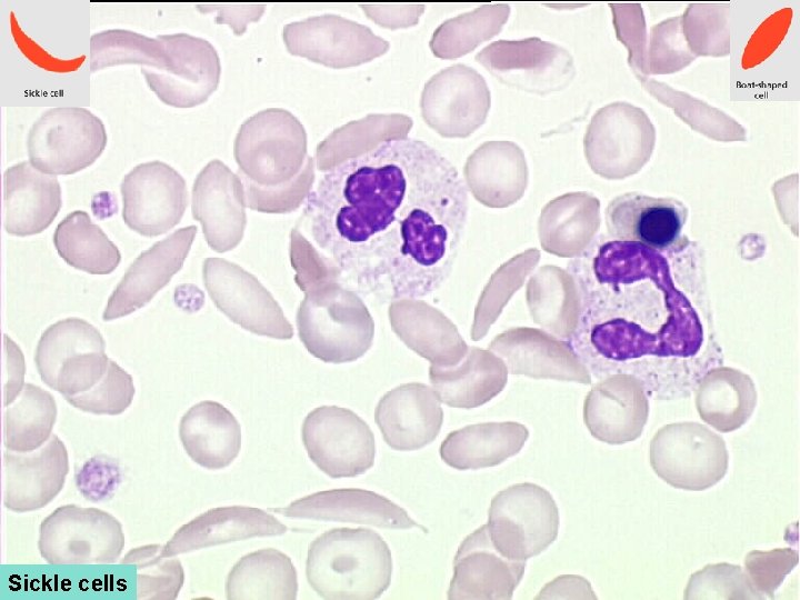 Sickle cells 