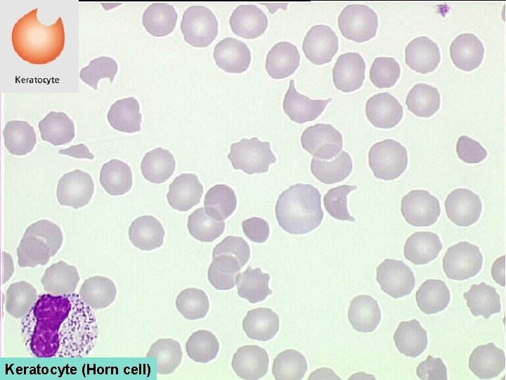 Keratocyte (Horn cell) 