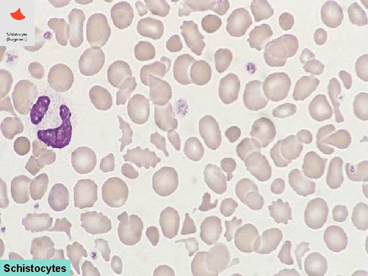 Schistocytes 