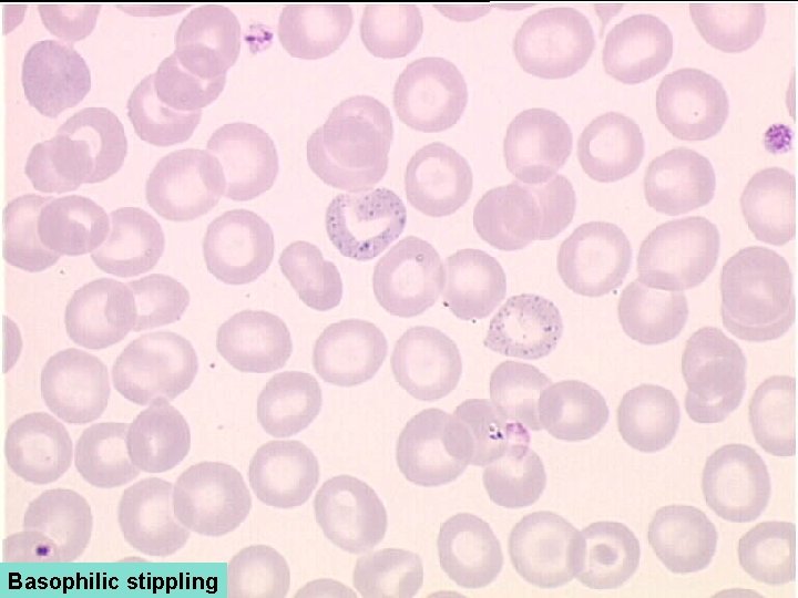 Basophilic stippling 