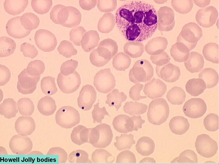 Howell Jolly bodies 