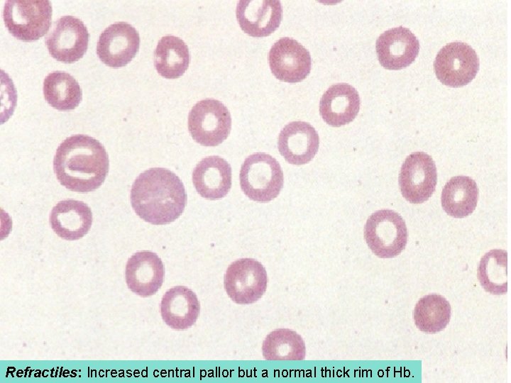 Refractiles: Increased central pallor but a normal thick rim of Hb. 