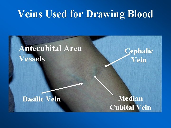 Veins Used for Drawing Blood Antecubital Area Vessels Basilic Vein Cephalic Vein Median Cubital