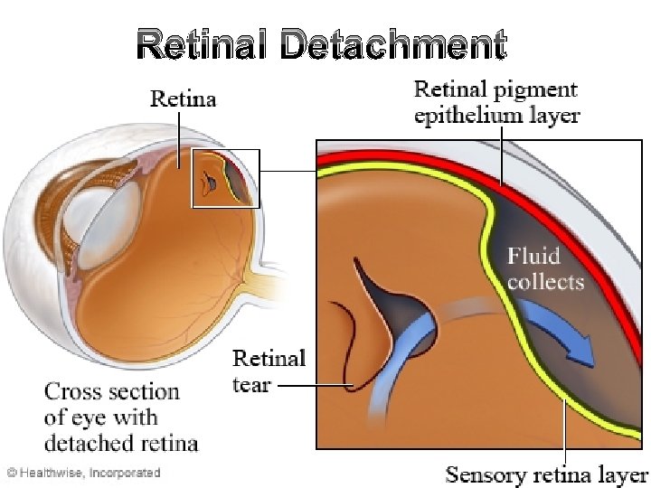 Retinal Detachment 