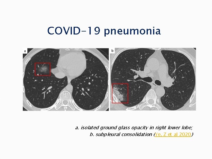 COVID-19 pneumonia a. isolated ground glass opacity in right lower lobe; b. subpleural consolidation