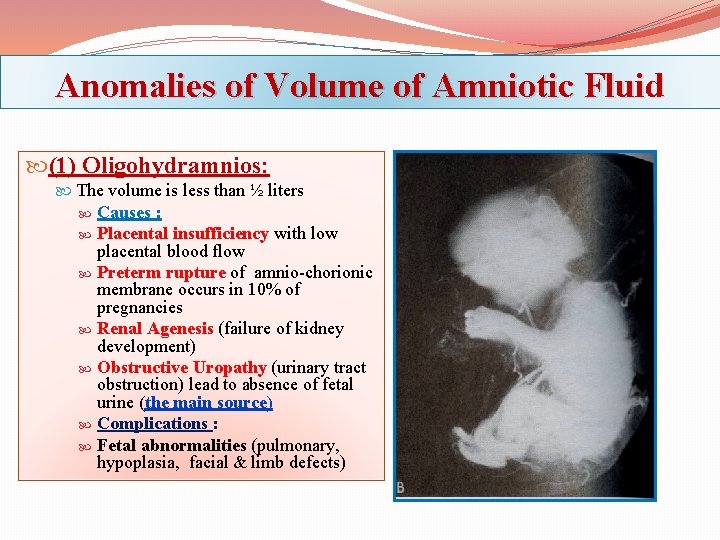 Anomalies of Volume of Amniotic Fluid (1) Oligohydramnios: The volume is less than ½