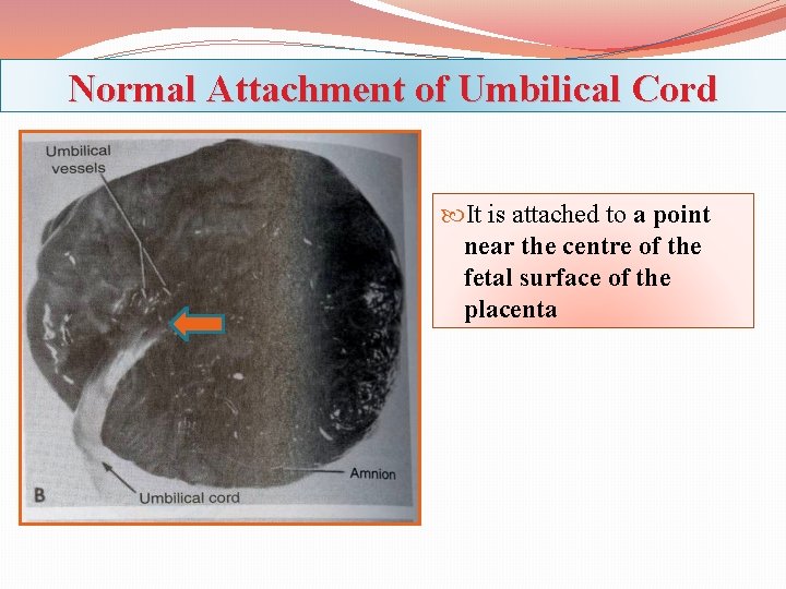 Normal Attachment of Umbilical Cord It is attached to a point near the centre