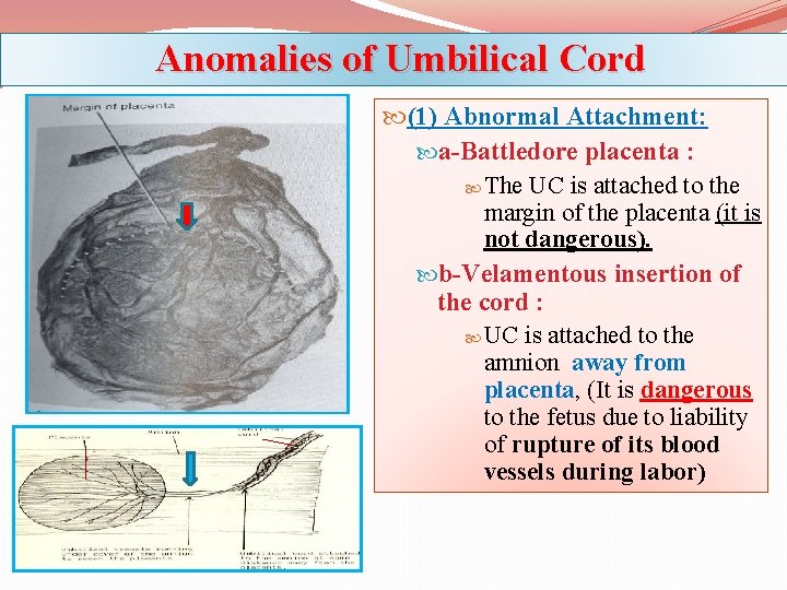 Anomalies of Umbilical Cord (1) Abnormal Attachment: a-Battledore placenta : The UC is attached